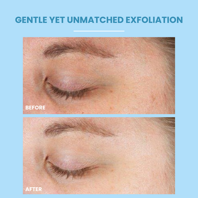 Before and after comparison of skin exfoliation on a blue background